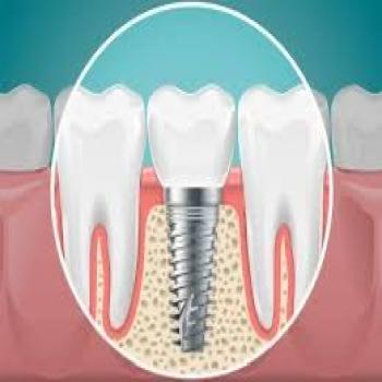 Implantes dentales sin cirugía